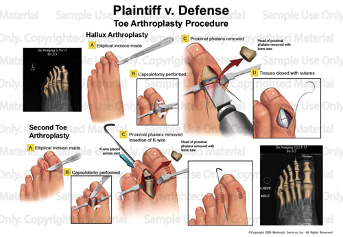 illustration-toe-arthroplasty-procedure-001
