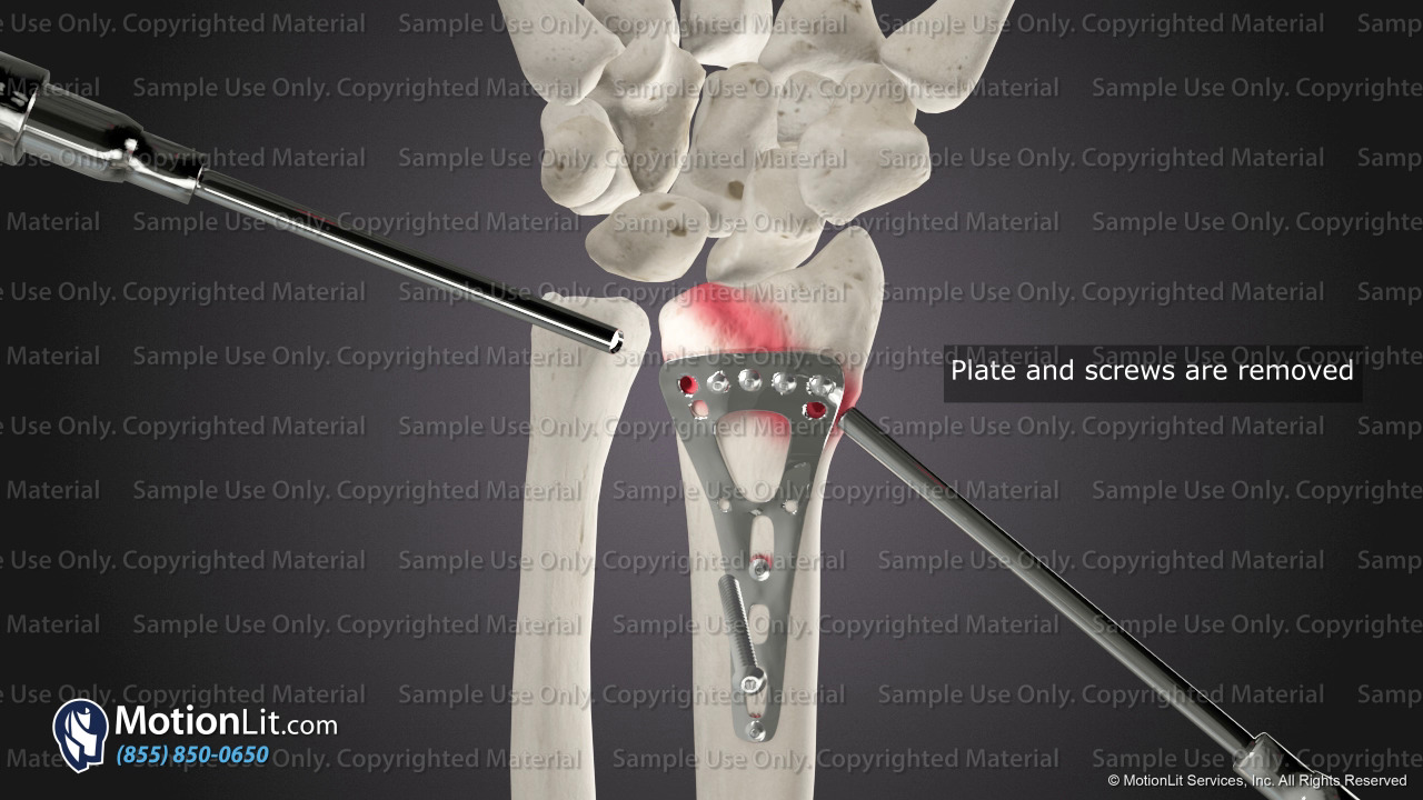 Wrist Hardware Removal & Arthroscopy MotionLit