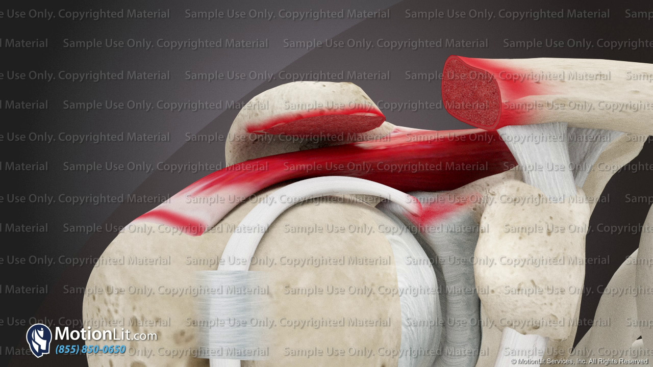 R Shoulder Arthroscopy MotionLit