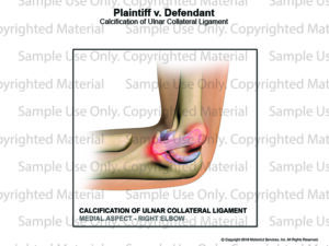 Calcification of Ulnar Collateral Ligament - MotionLit