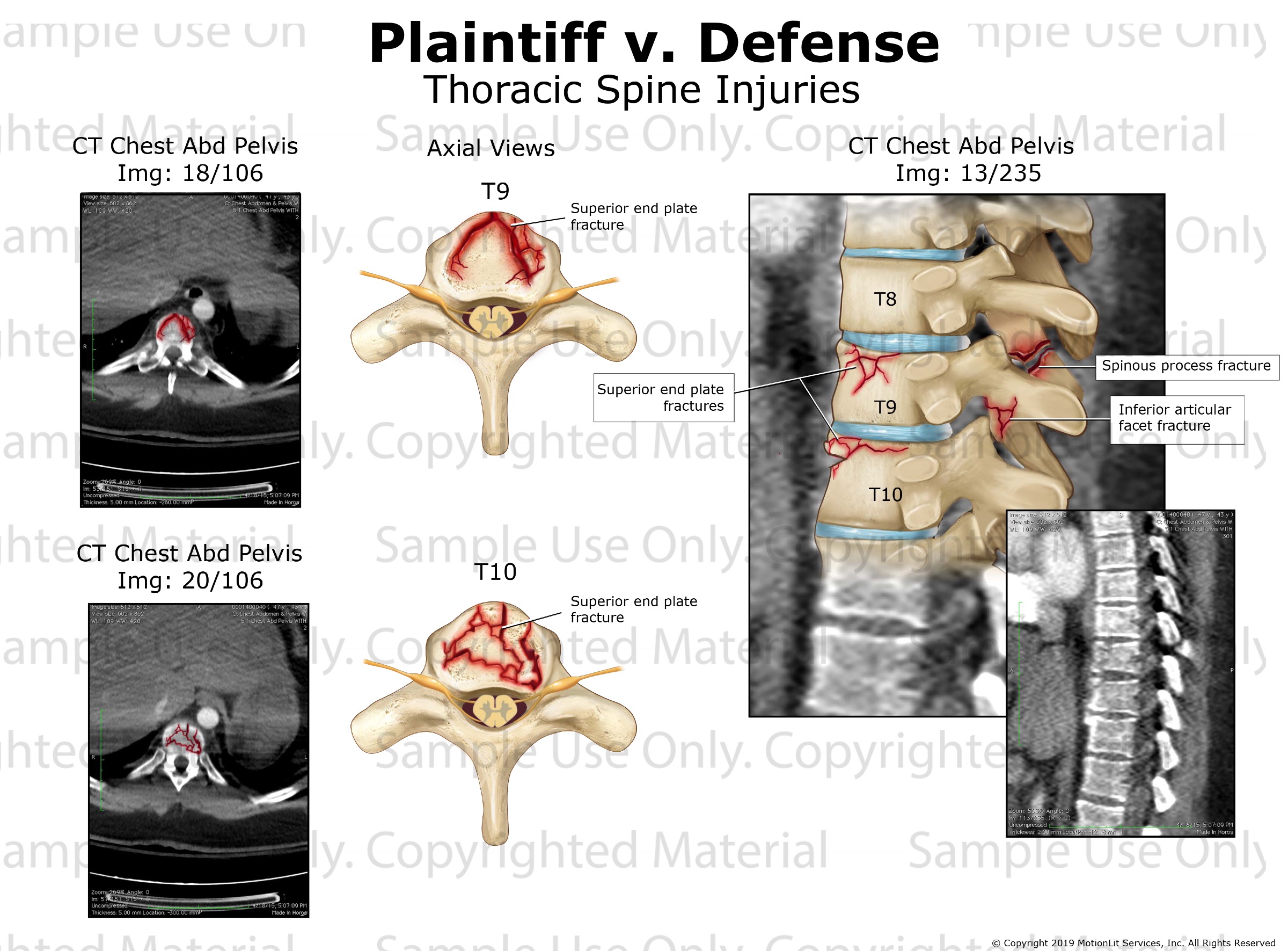 icd 10 code for multiple thoracic spine fractures