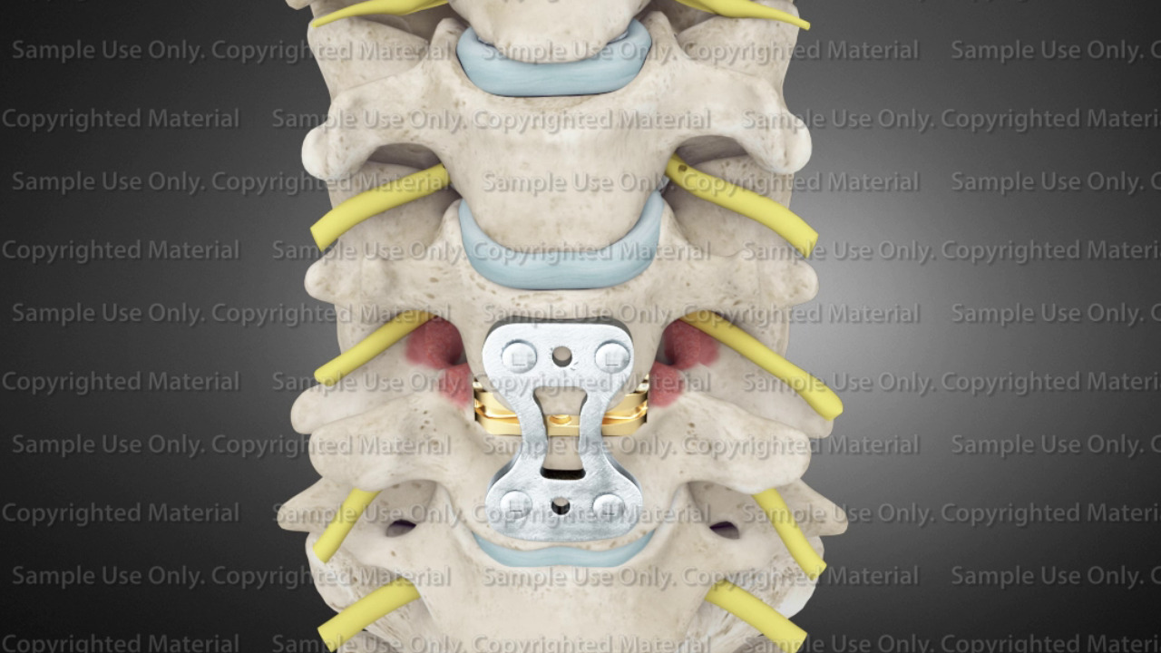 Cervical Spine Fusion C3-C5 ACDF – Stock Trial Exhibits