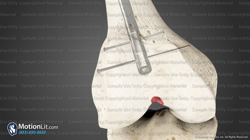 R Femur Retrograde Intramedullary Nail - MotionLit