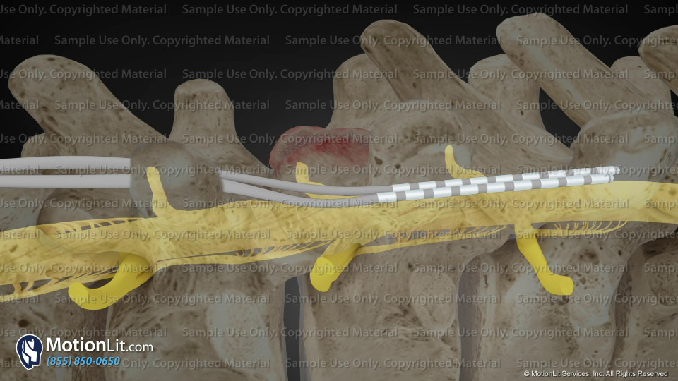 Spinal Cord Stimulator Implant MotionLit