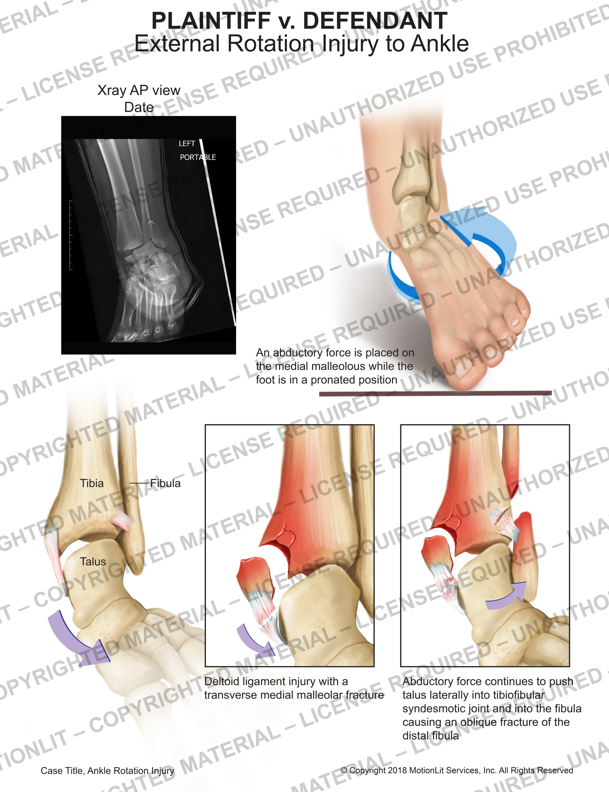 Ankle Eversion Injury