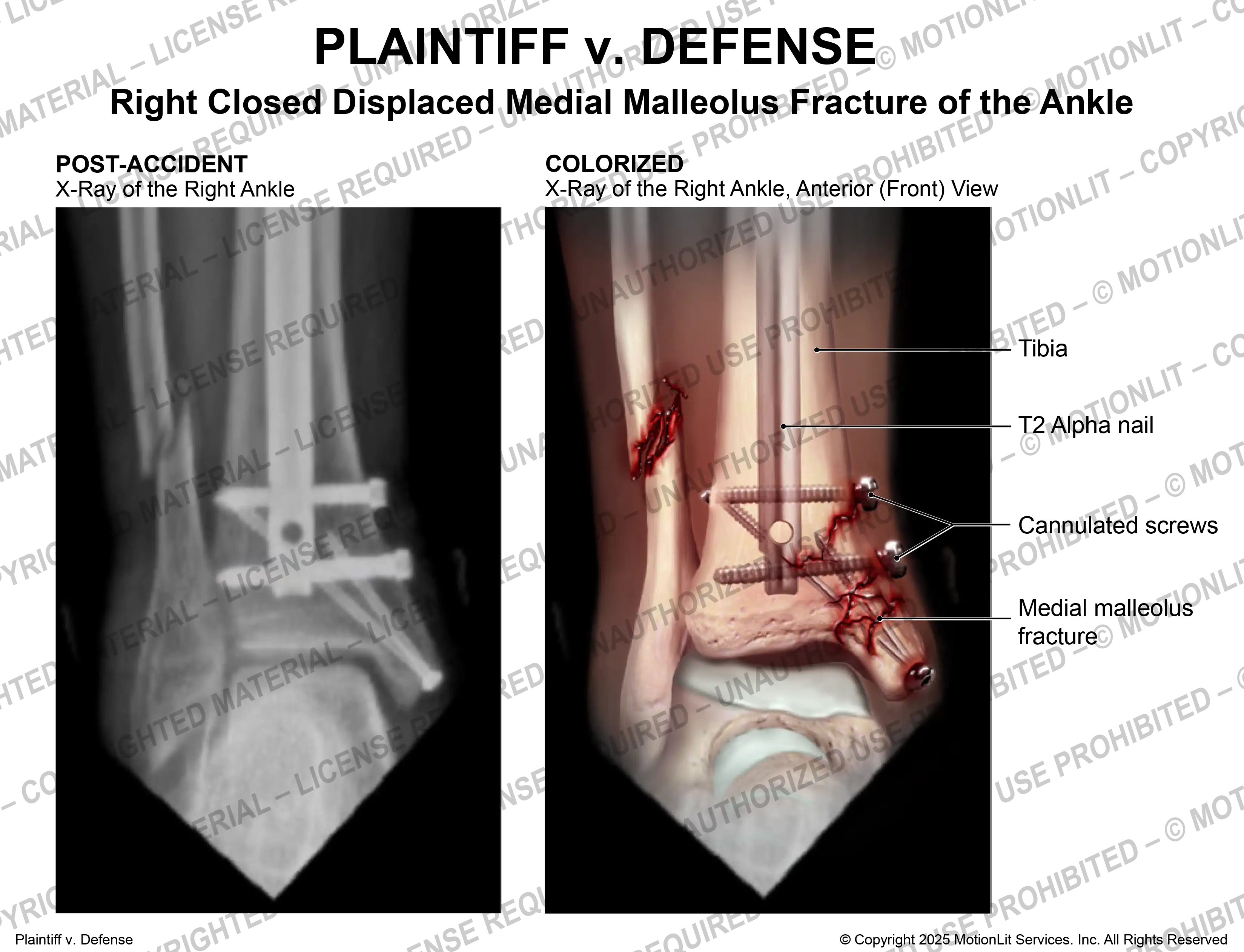 Ankle