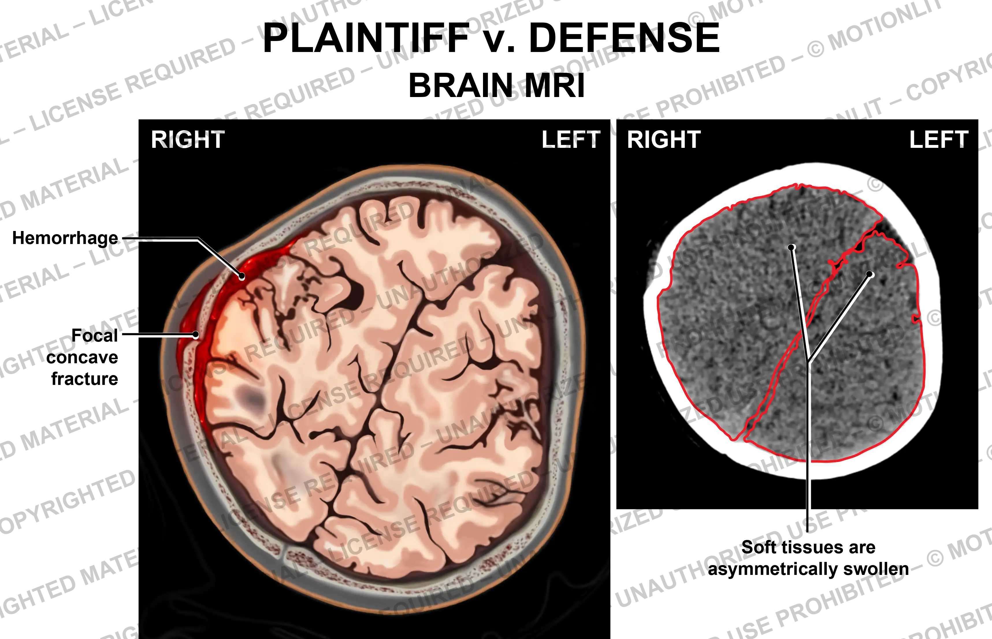 Brain MRI