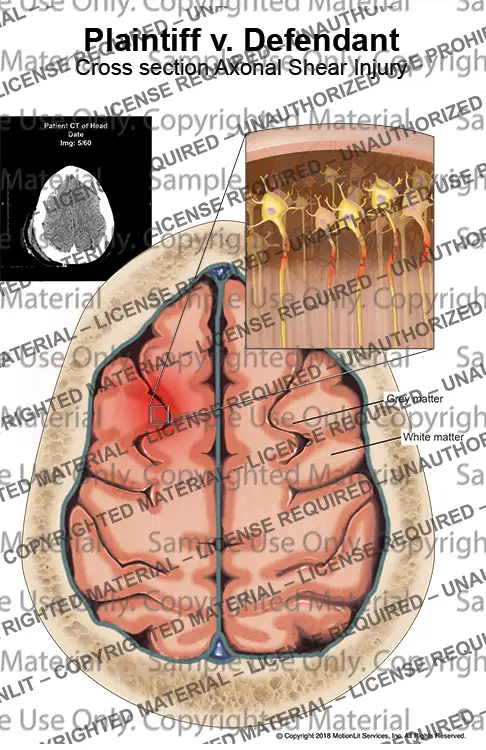 Axonal Shear Injury