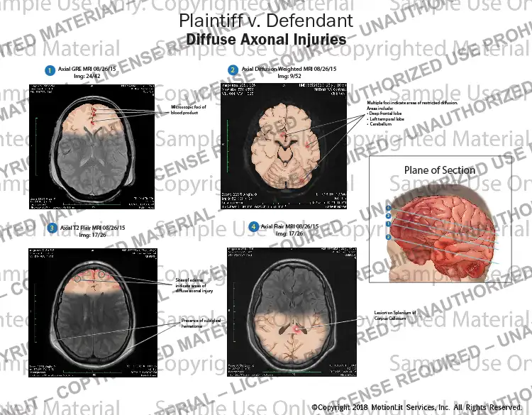 Diffuse Axonal Injuries