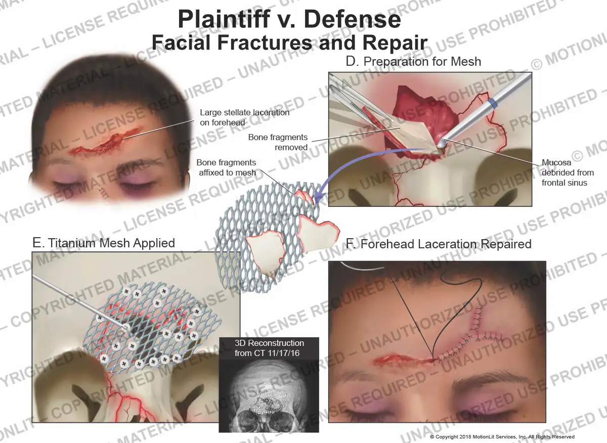 Facial Fracture Repair