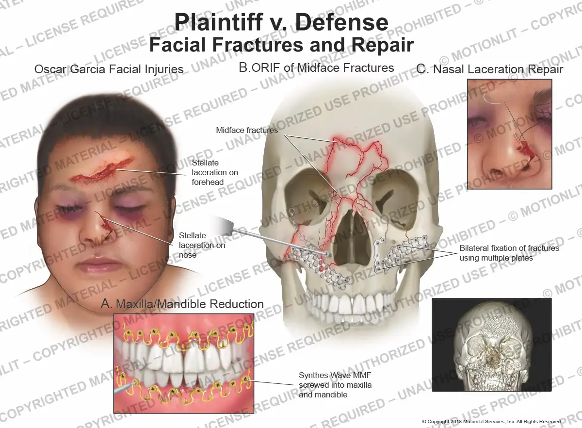 Facial Fracture