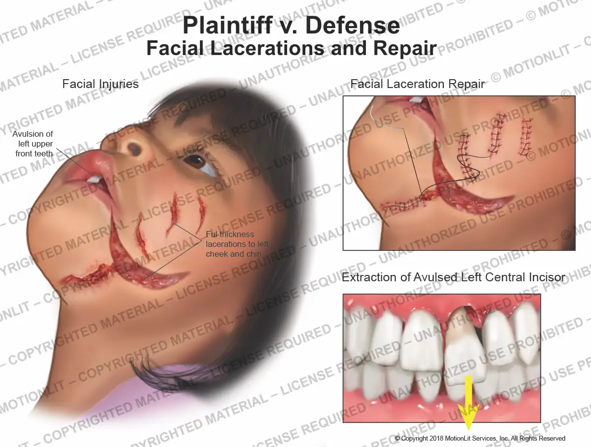 Facial Laceration