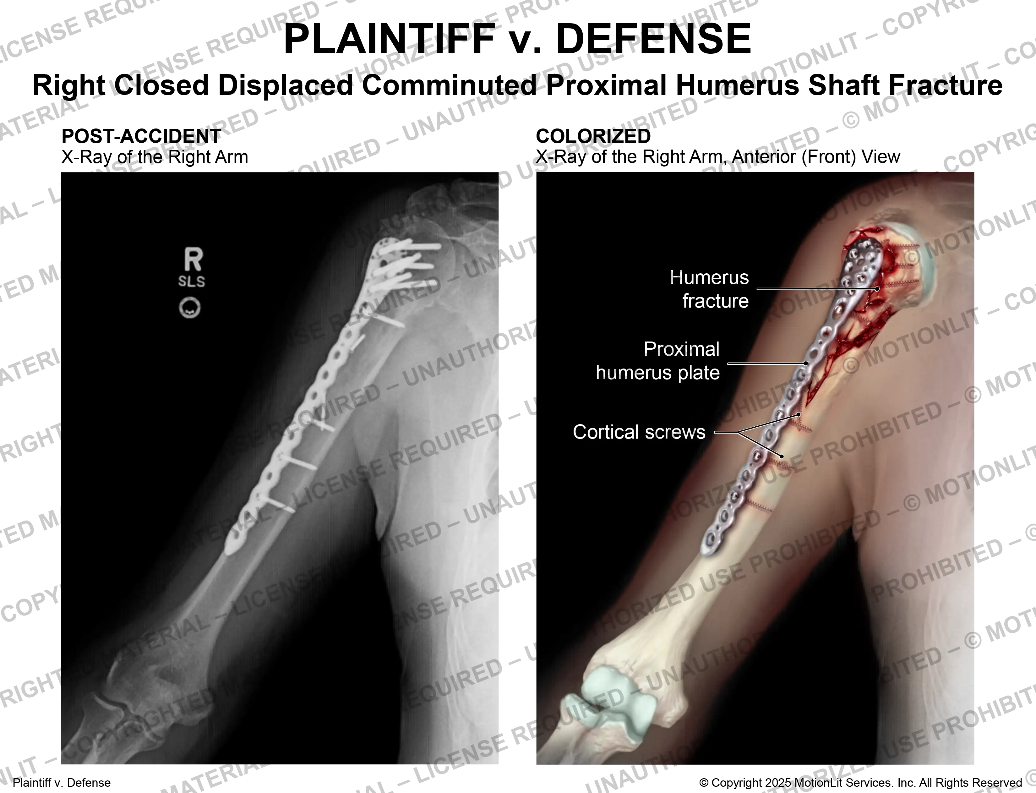 Humerus Fracture