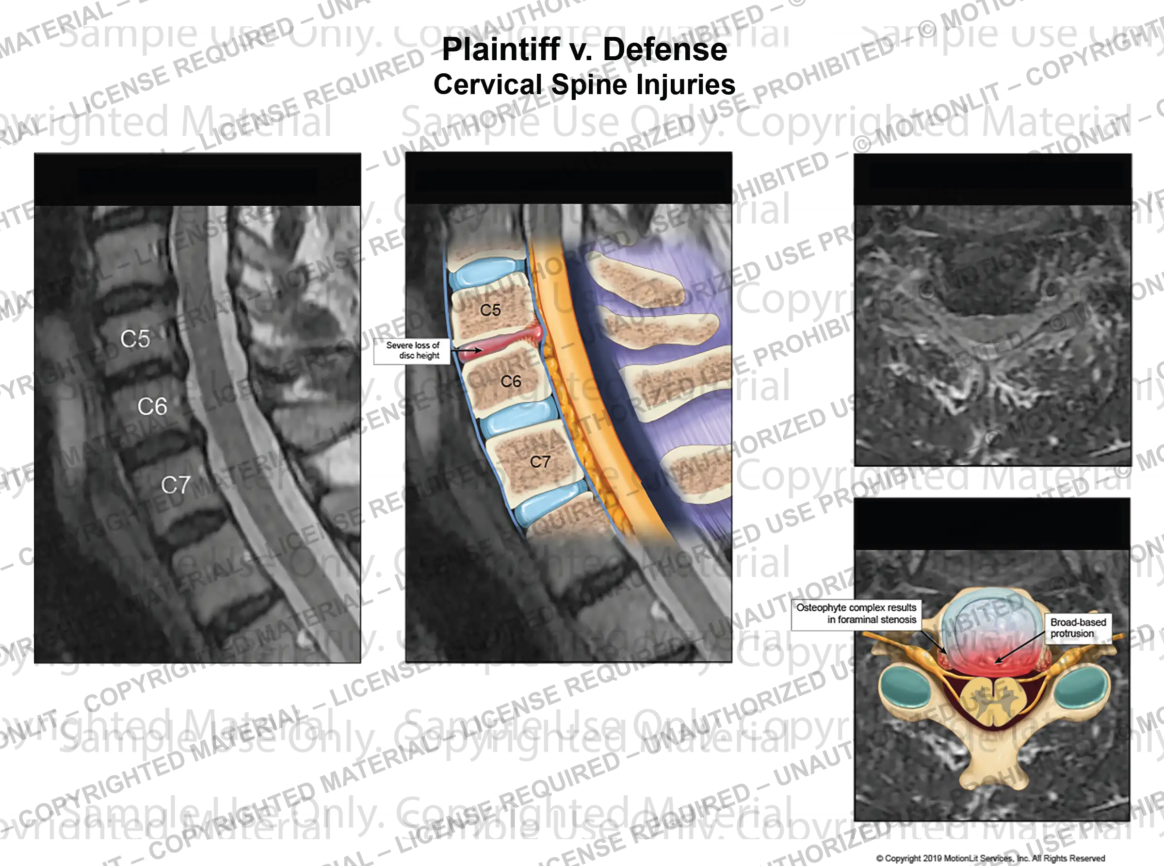 Cervical Injury