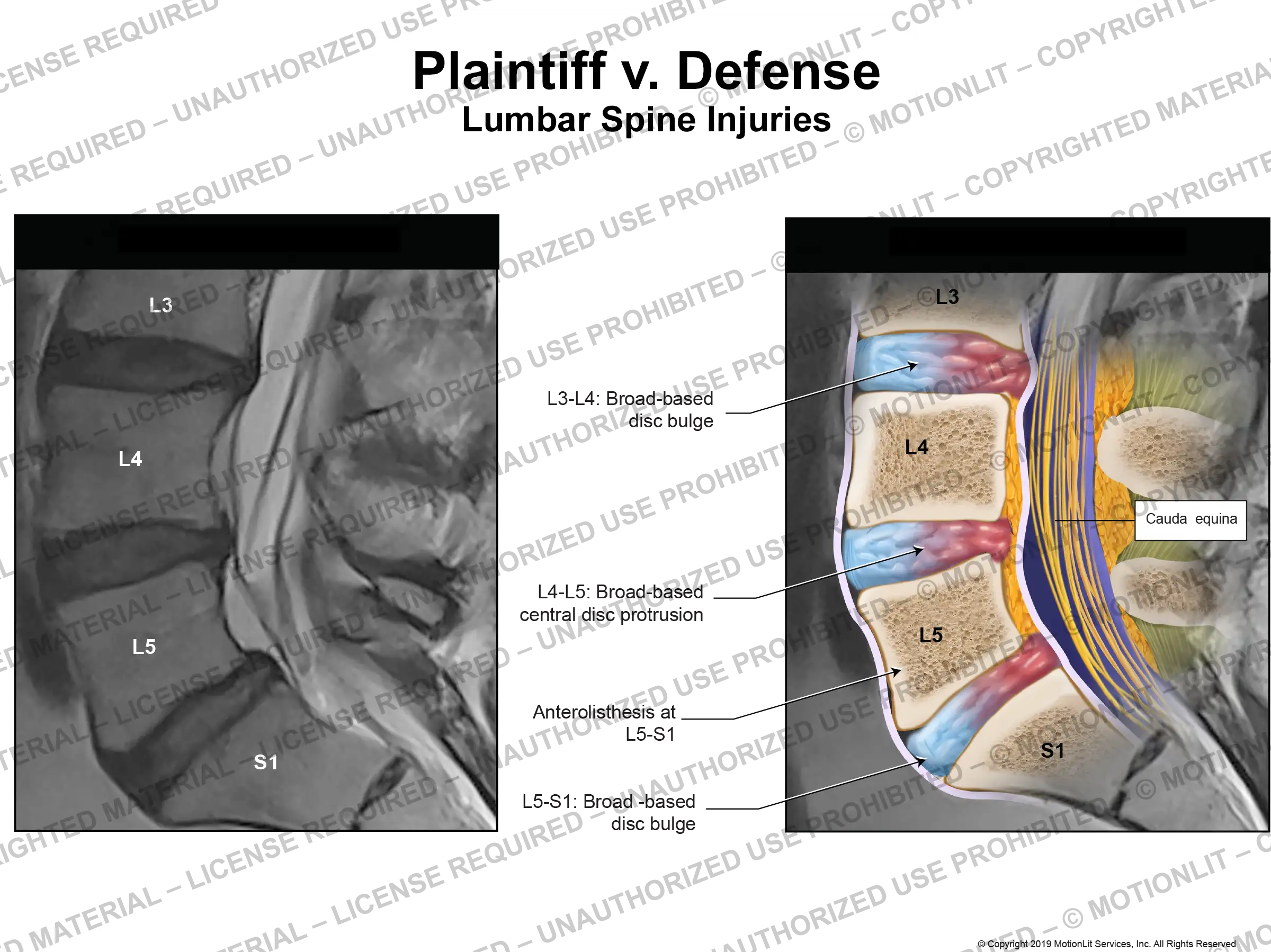L3 S1 Disc Injuries