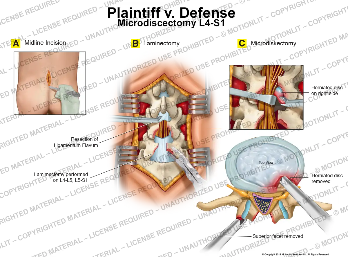 Lumbar Microdiscectomy