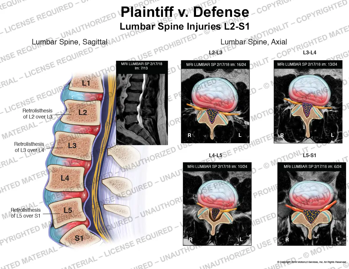 Lumbar Spine MRI