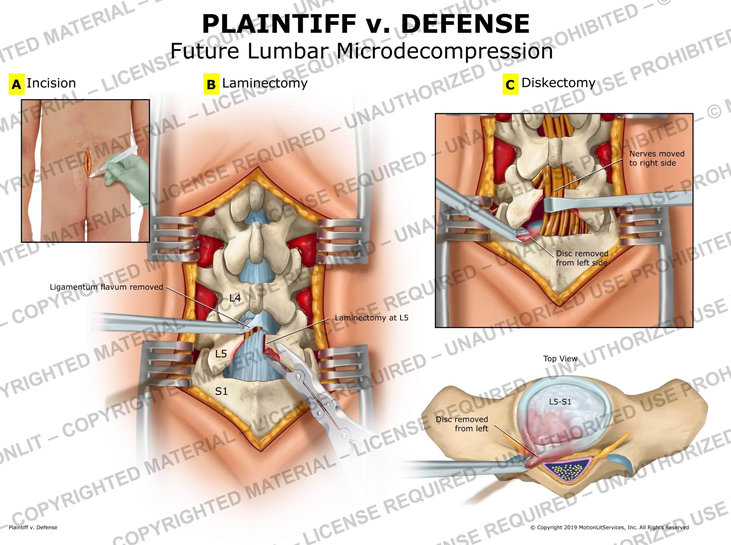 Lumbar Decompression