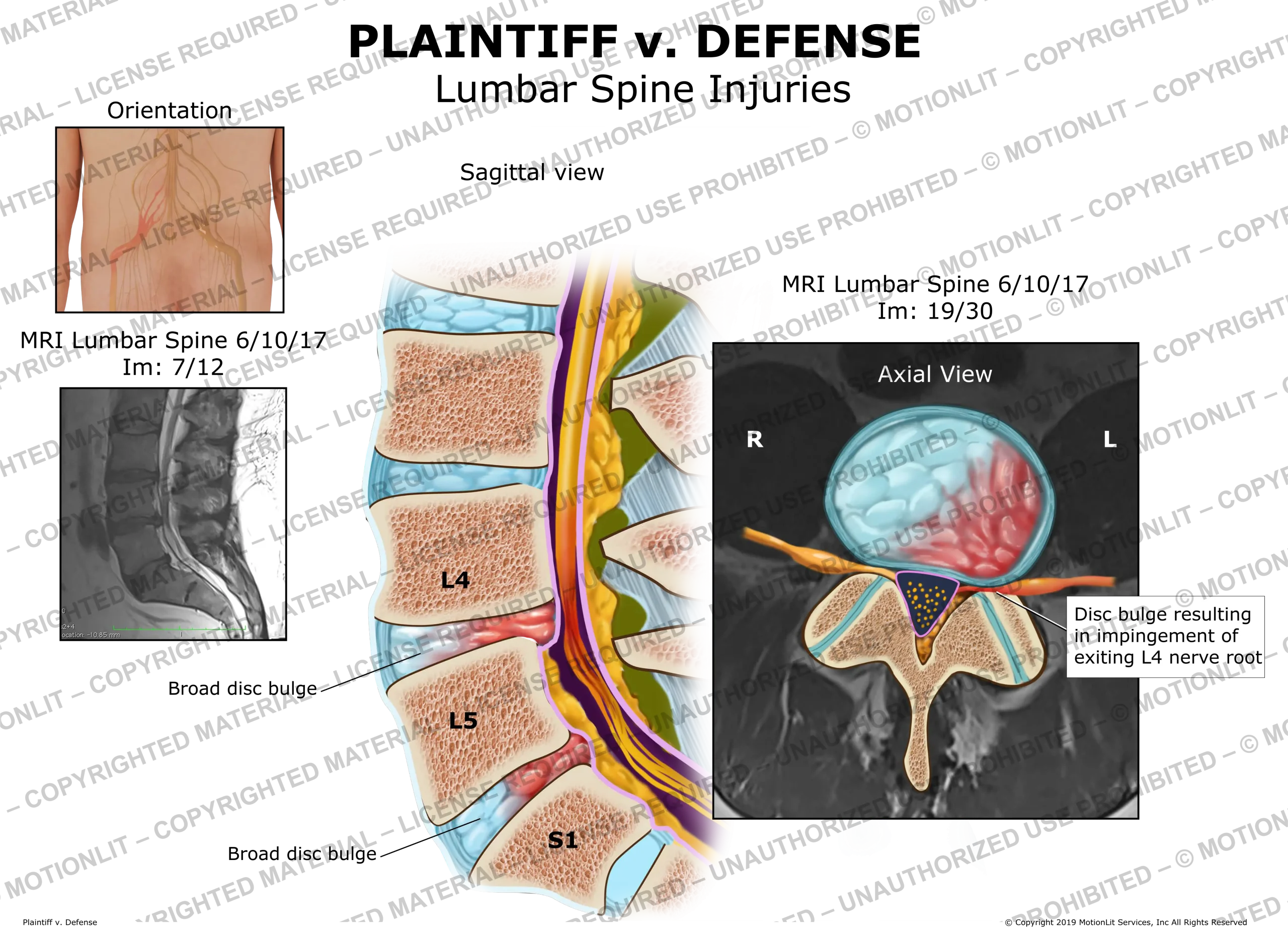 Lumbar Injuries