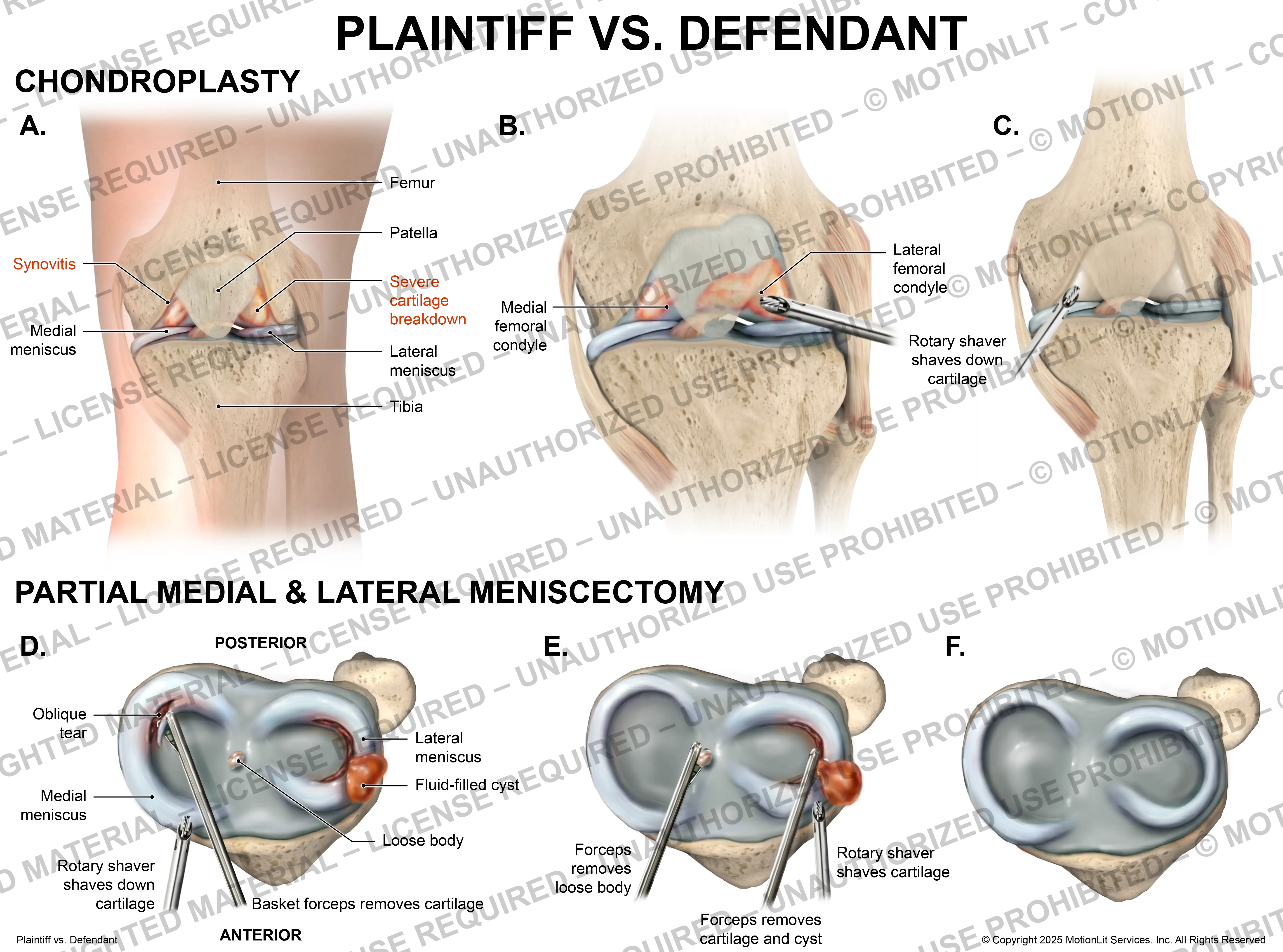 Meniscectomy and Chondroplasty