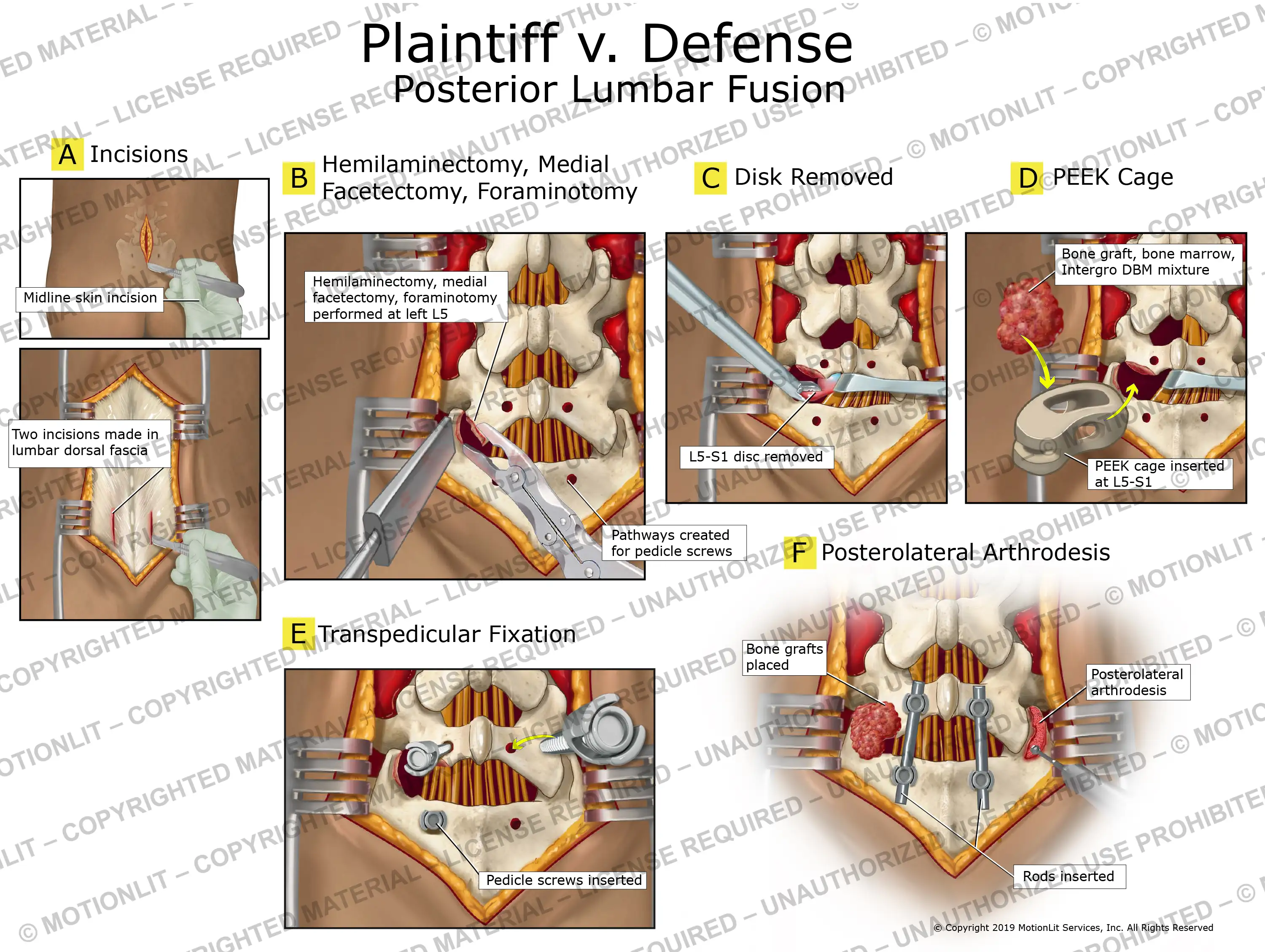 Posterior Lumbar Fusion