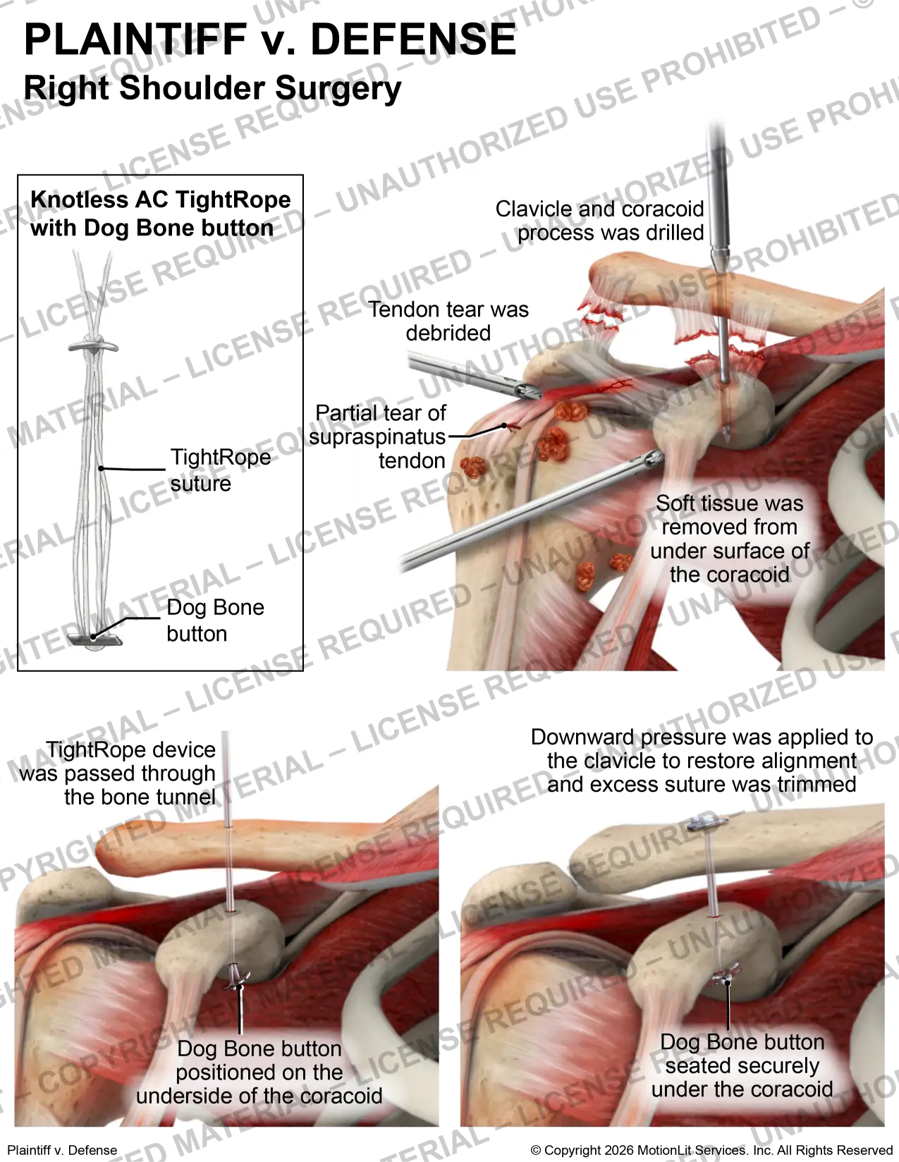 Right Shoulder Surgery