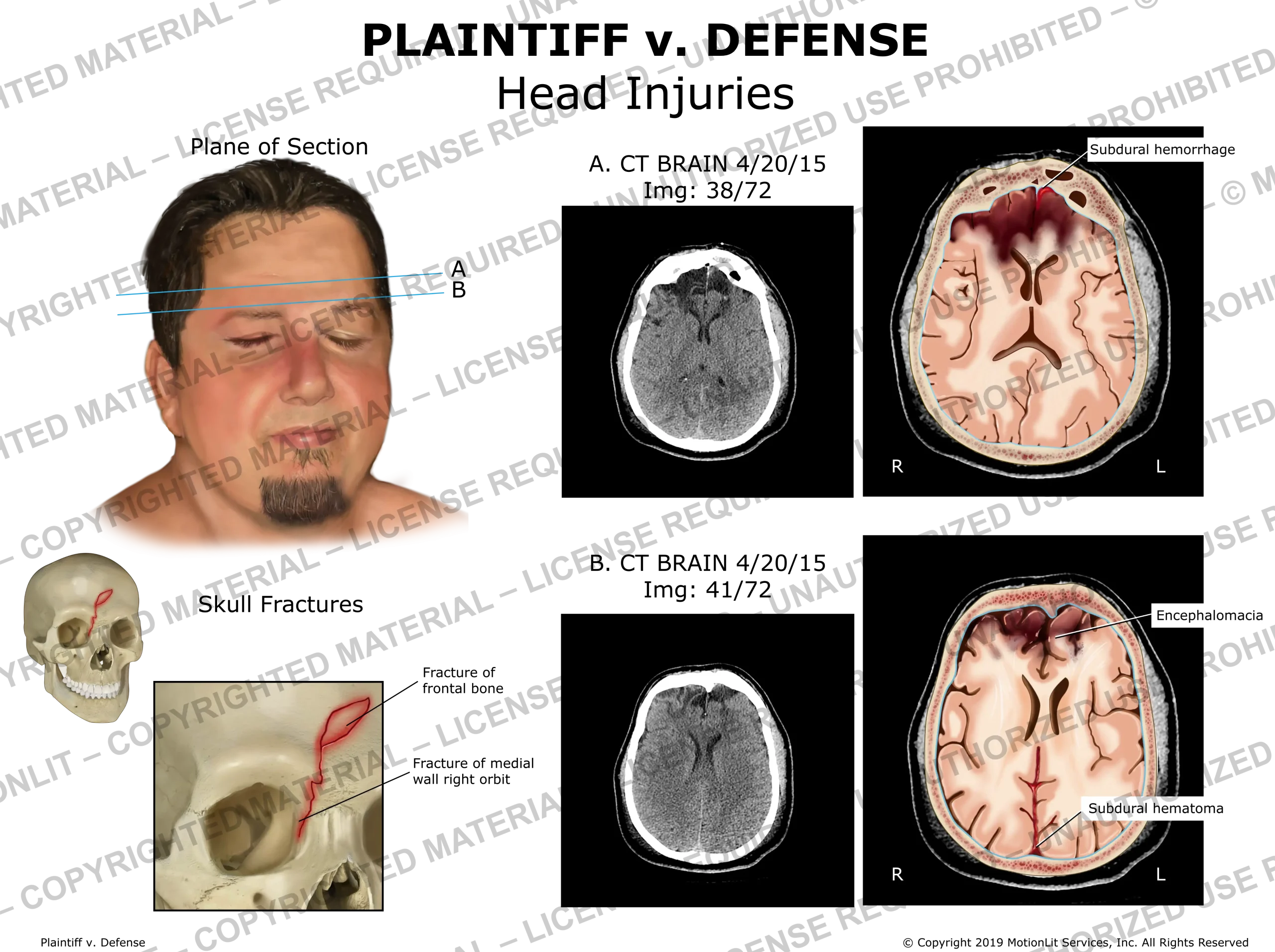 Skull and Brain Injuries