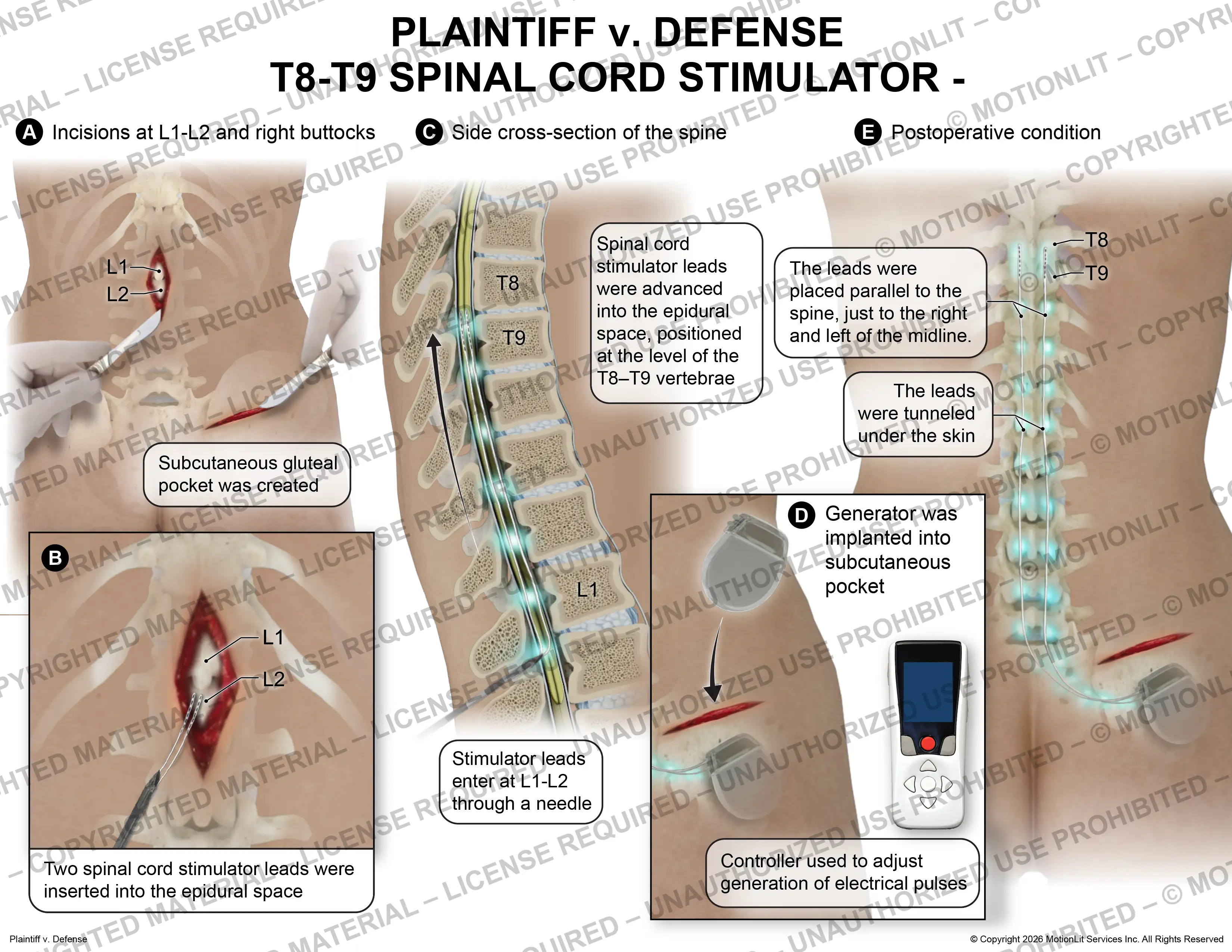 Spinal Cord Stimulator