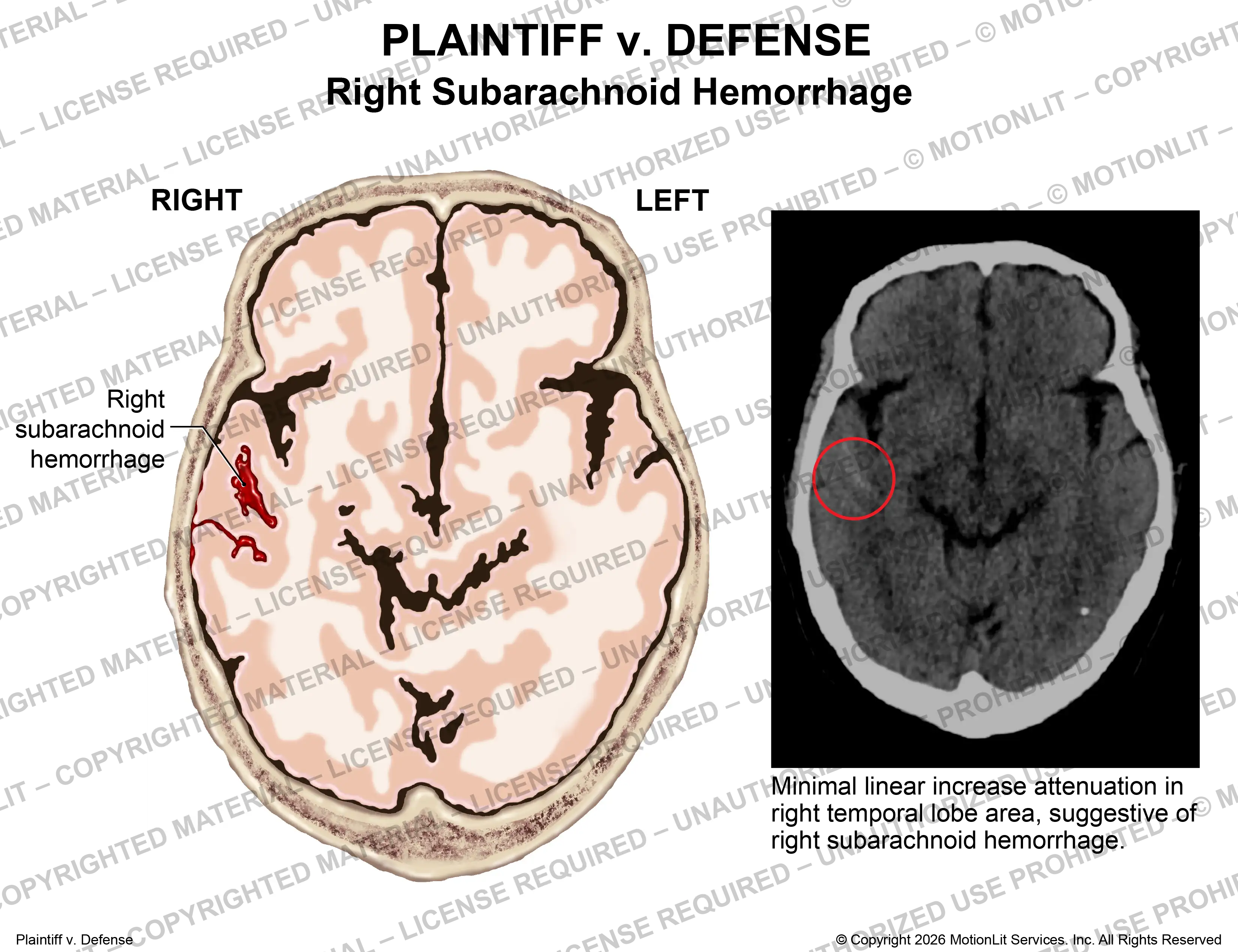 Subarachnoid Hemorrhage