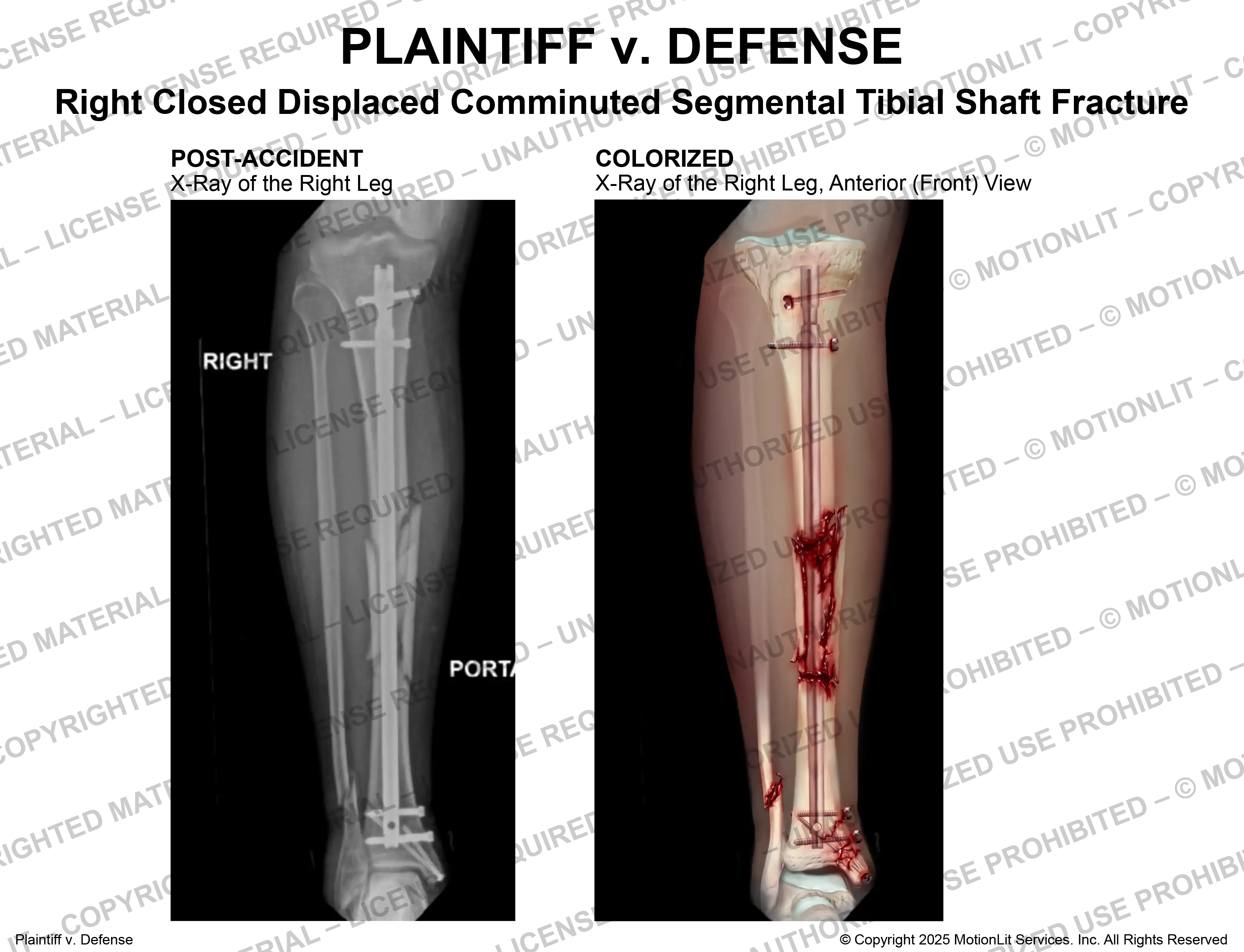 Tibia Fracture