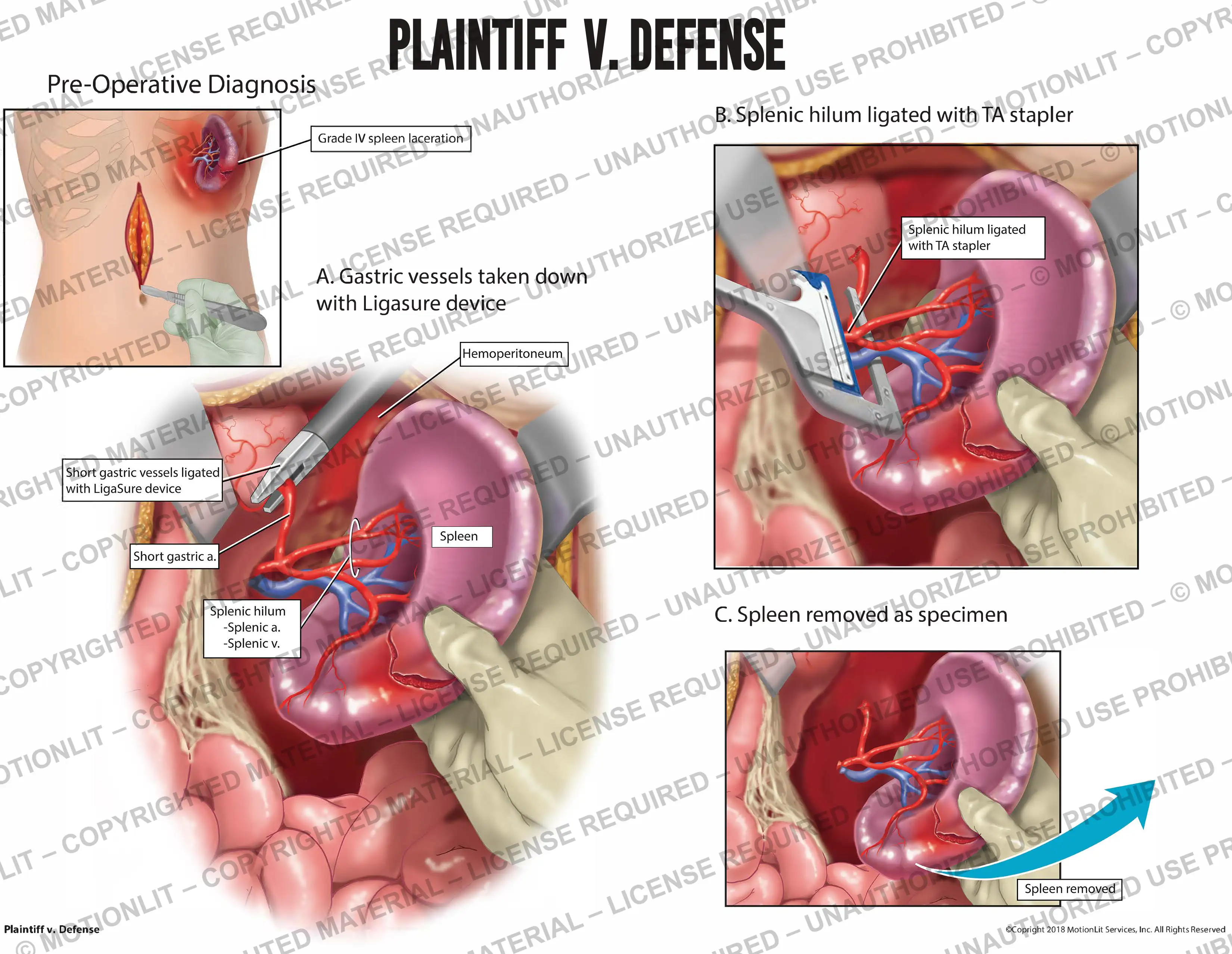 Splenectomy