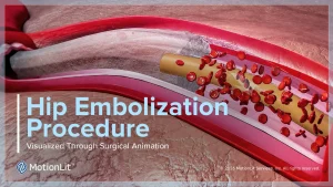 Learn how MotionLit hip embolization surgical animation helped illustrate pelvic trauma and secure a $4.5 million pre-mediation settlement.