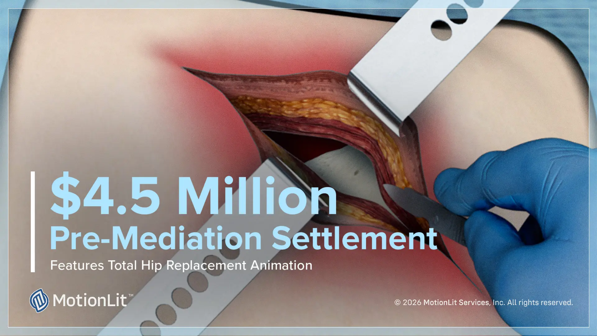 4.5 million pre mediation settlement