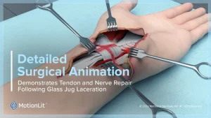 Surgical animation still showing flexor tendon and ulnar nerve repair in a lacerated wrist, used as a trial exhibit